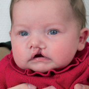 Schisis en borstvoeding